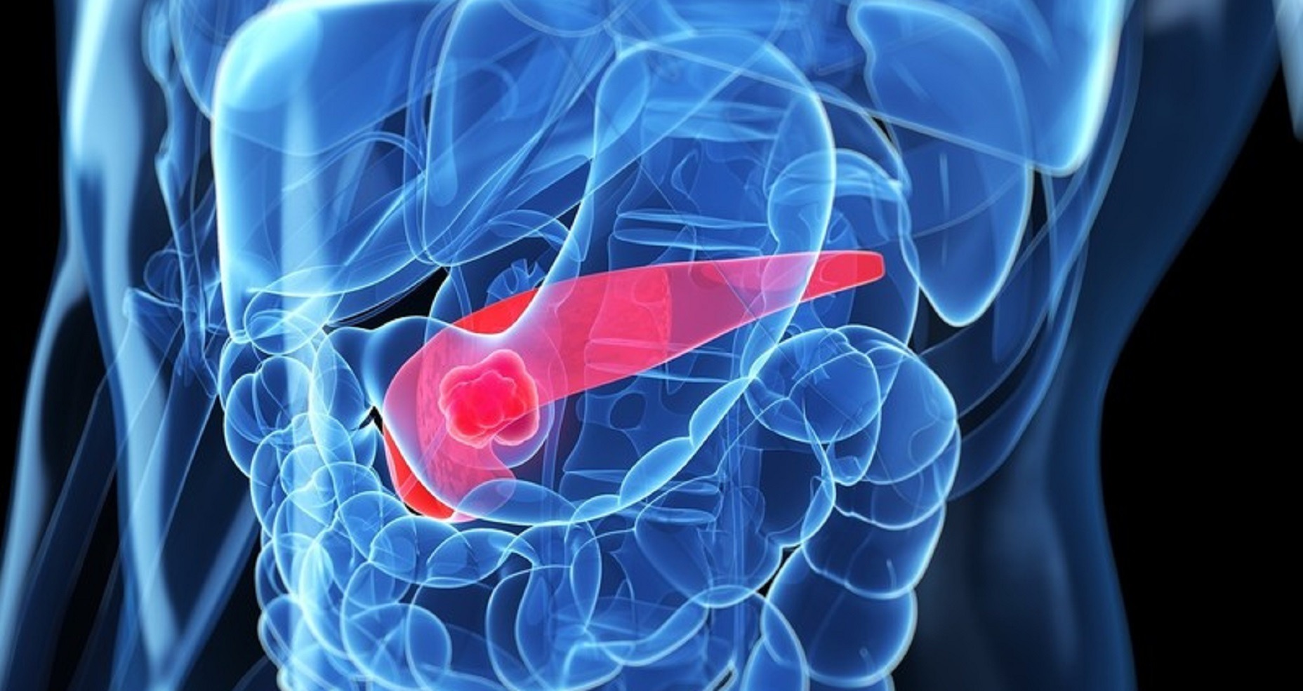 cancro al pancreas sintomi