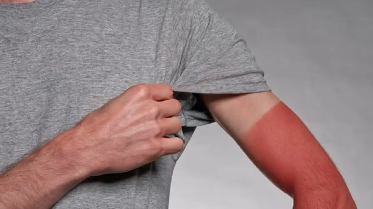 Sunburn Challenge: la pericolosa tendenza dell’abbronzatura estrema tra i giovani