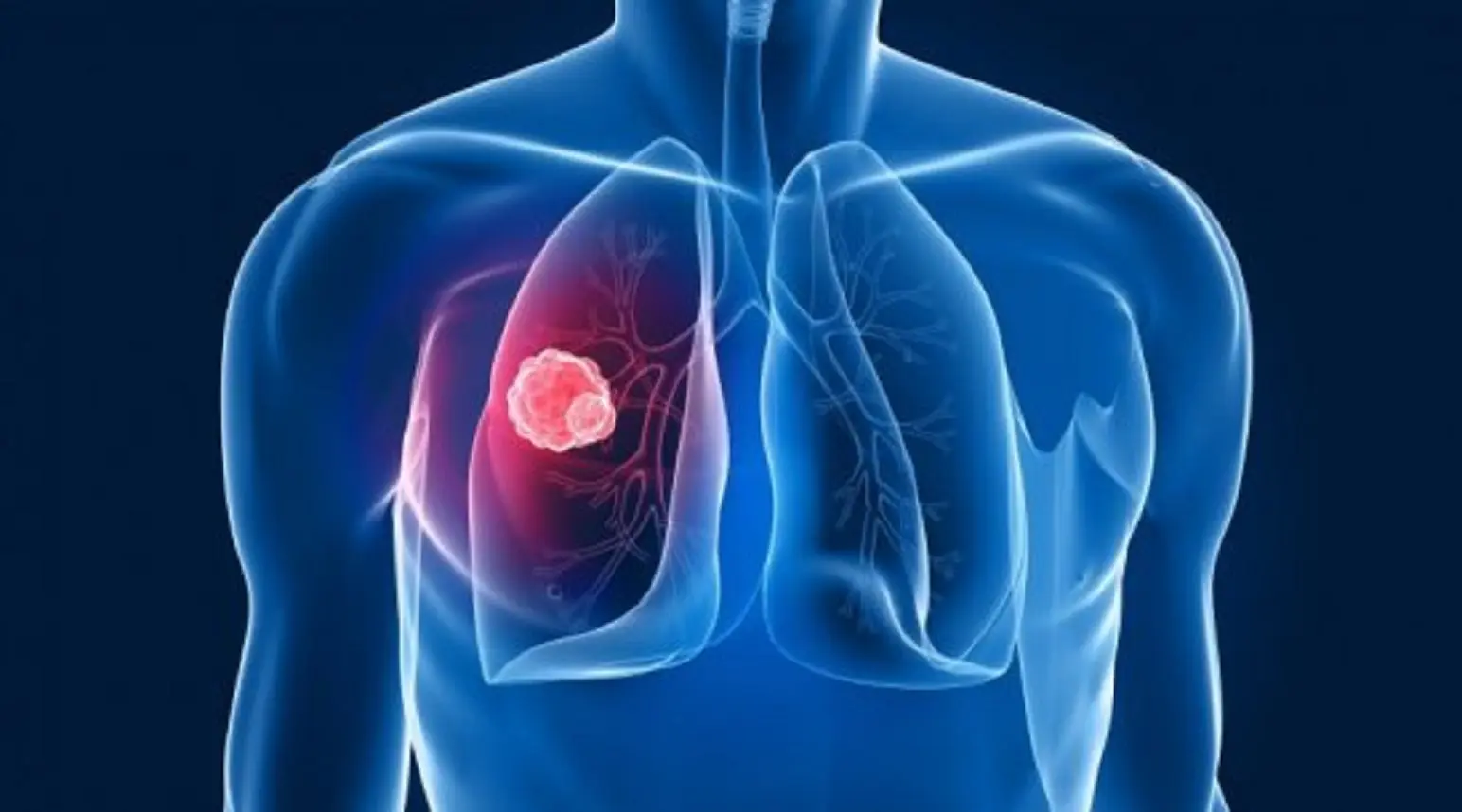 Cancro del polmone, EGFR mutato: Osimertinib più chemioterapia apre una nuova era Cancro del polmone, EGFR mutato: Osimertinib più chemioterapia apre una nuova era