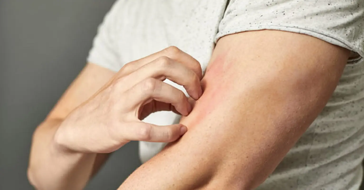 Il segreto del prurito svelato: perché grattarsi dà sollievo e quando fermarsi Il segreto del prurito svelato: perché grattarsi dà sollievo e quando fermarsi