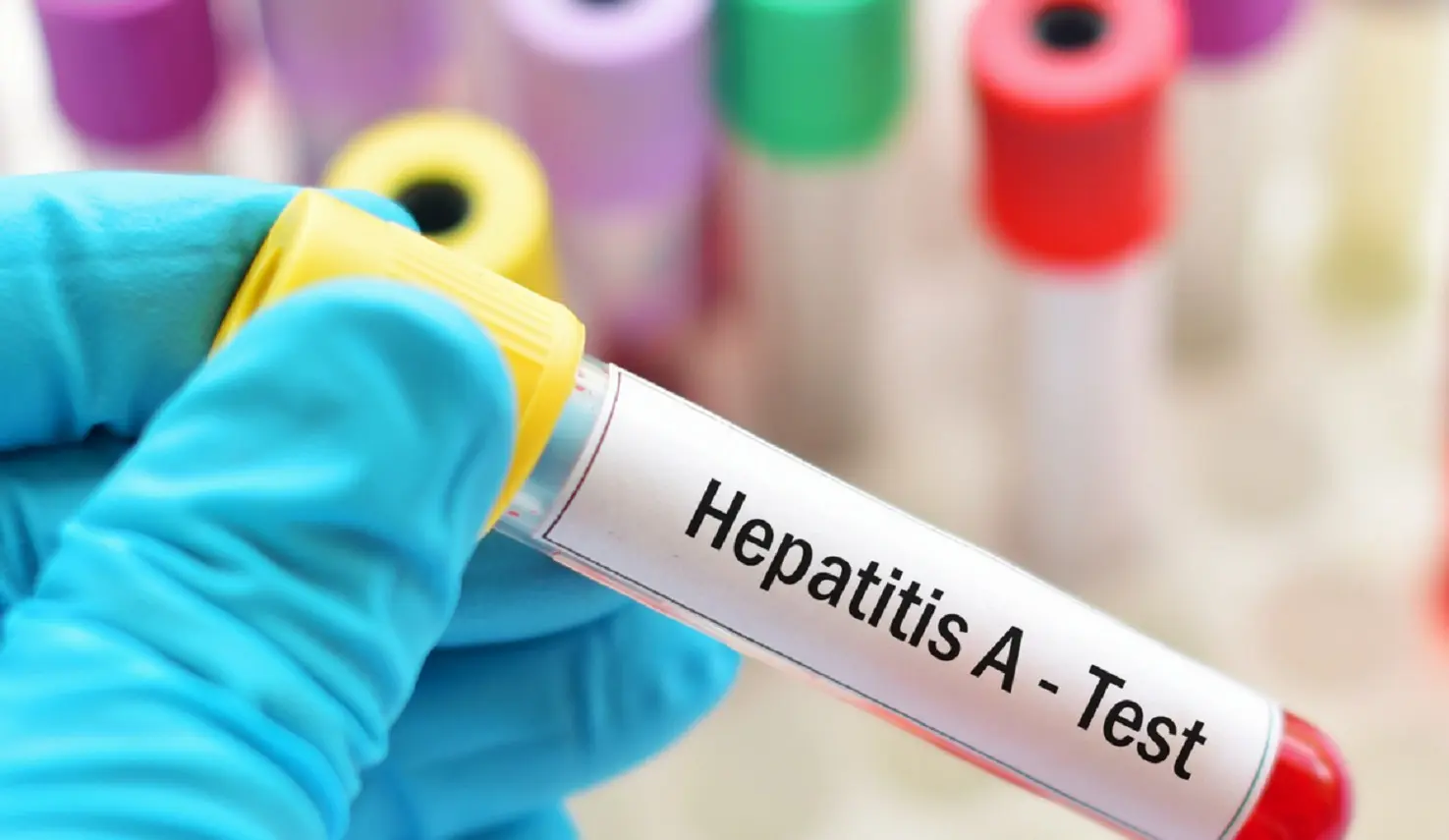 Epatite A, scatta l’allarme a Napoli: divieto sulle cozze e controlli a tappeto