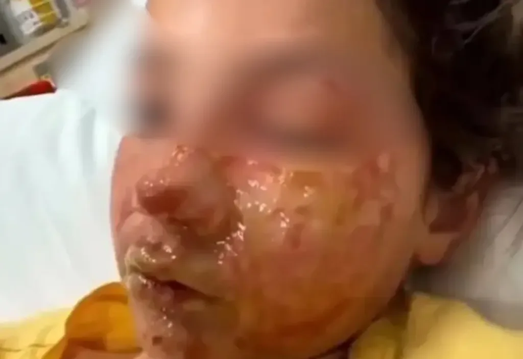 Le gravi conseguenze del gel bollente